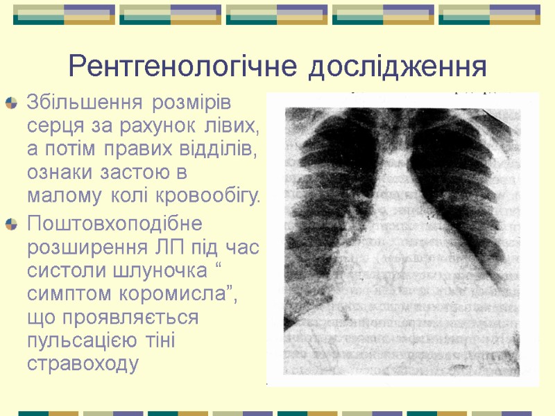 Рентгенологічне дослідження Збільшення розмірів серця за рахунок лівих, а потім правих відділів, ознаки застою